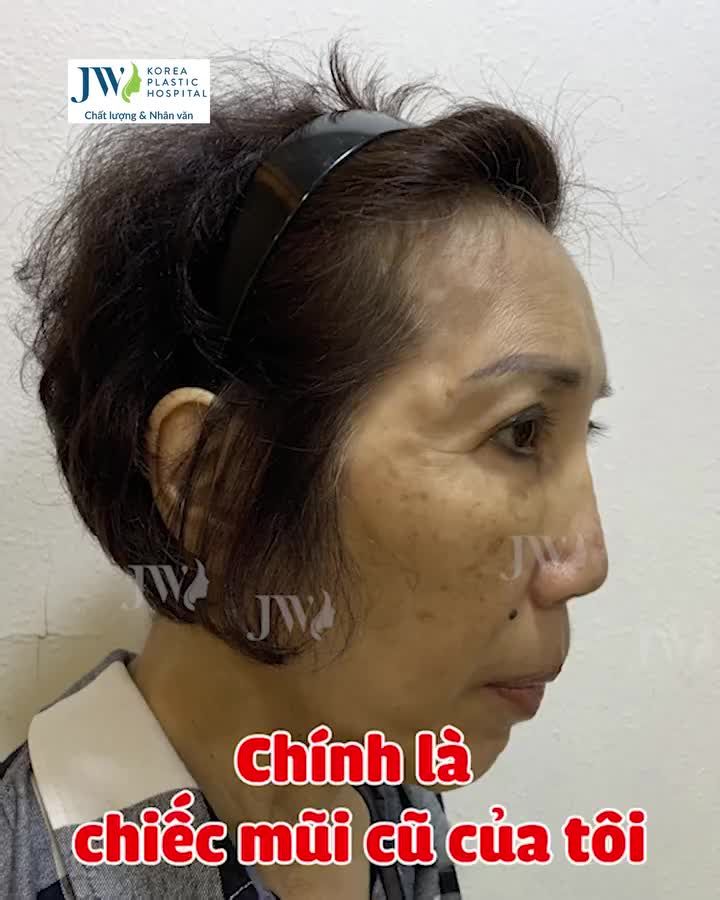 Xem thêm 243 video Nâng Mũi của bác sĩ Bs Nguyễn Phan Tú Dung