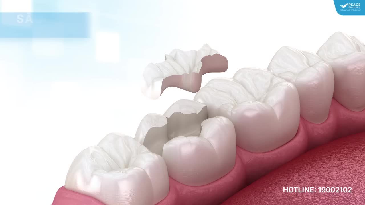 SÂU RĂNG, VỠ NHIỀU MÔ RĂNG & GIẢI PHÁP INLAY/ONLAY (TRÁM SỨ)