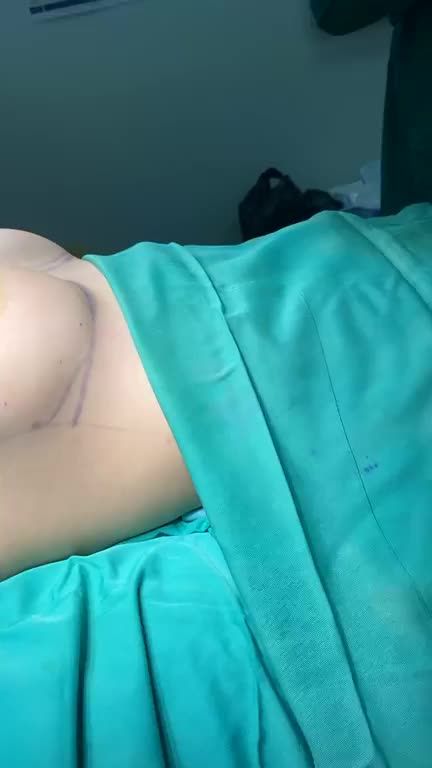 Case nâng ngực cho khách hàng