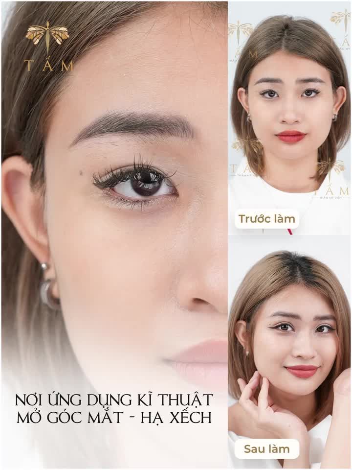 Đi đầu phong trào mở góc mắt tại Việt Nam, TMV Tấm tự hoà là nơi mang lại vẻ đẹp hoàn hảo cho đôi mắt của bạn.