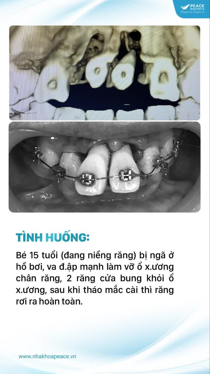 VA ĐẬP RĂNG LUNG LAY MẠNH HOẶC RƠI HẲN RA NGOÀI: Hãy bình tĩnh và xử lý đúng cách!