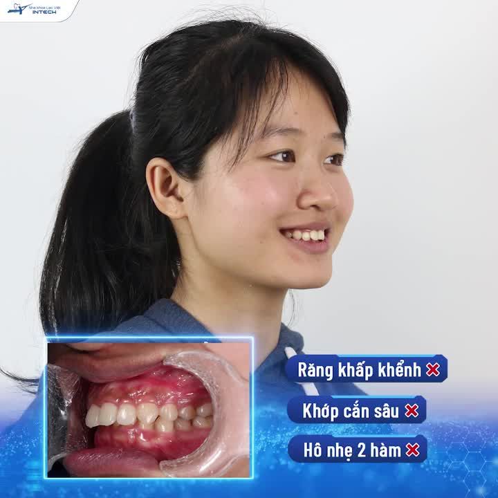 LOẠI BỎ RĂNG HÔ - KHỚP CẮN SÂU KHÔNG CẦN NHỔ RĂNG NHỜ CÔNG NGHỆ X-MATRIX