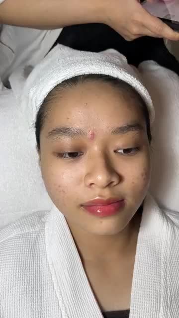 MỤN CẢI THIỆN ĐÁNG KỂ chỉ sau 1 buổi ĐIỀU TRỊ tại Khoa Thẩm mỹ da JW Loại bỏ MỤN CÁM, MỤN ẨN