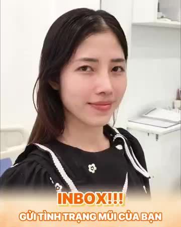 Ngỡ ngàng kết quả mũi siêu tự nhiêu sau 10 ngày thực hiện dịch vụ tại thẩm mỹ DrD.