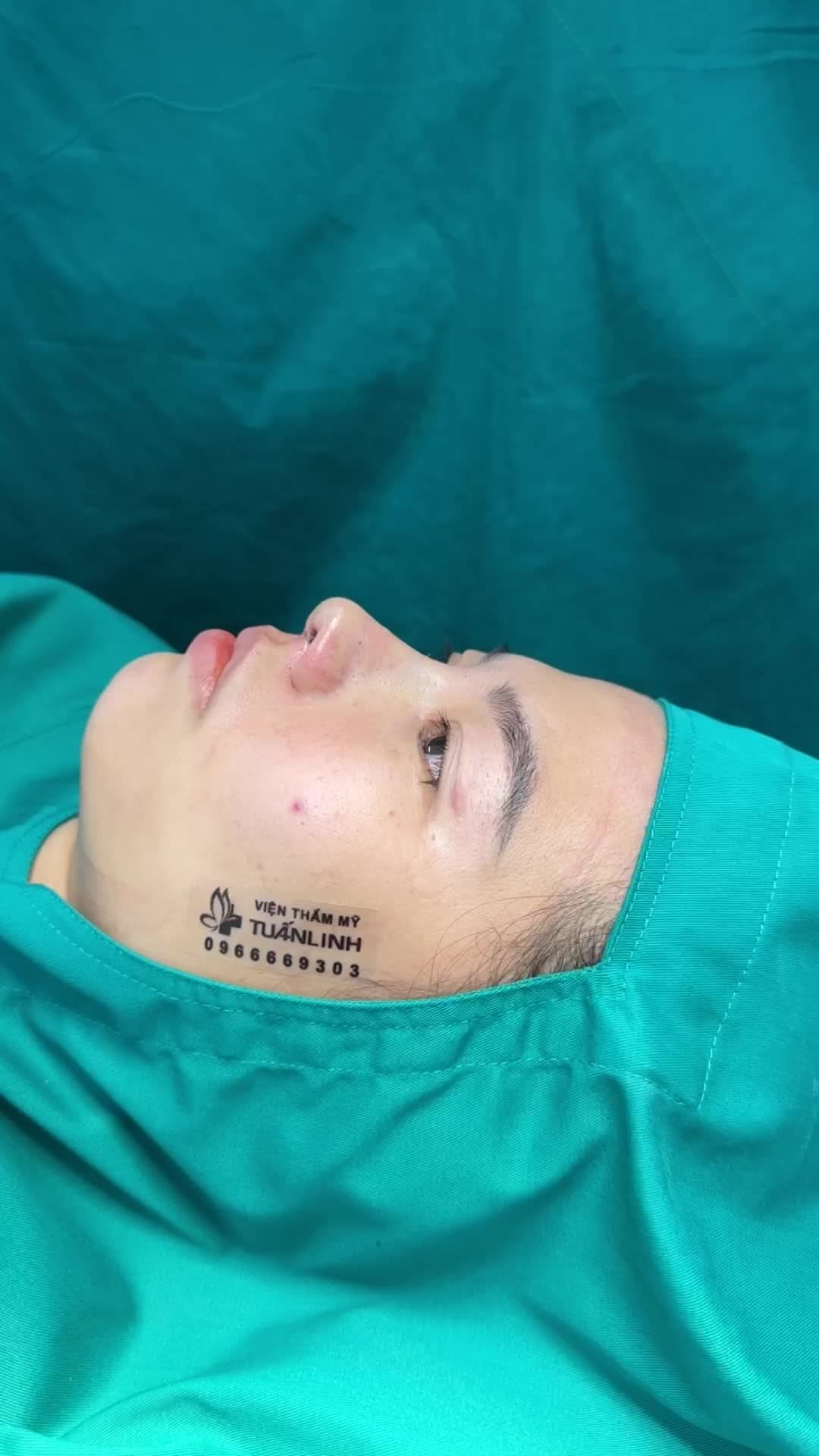 Nâng mũi cấu trúc - Dáng mũi Sline tự nhiên sau 90 phút!!
