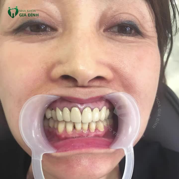 CHỊ KHÁCH VƯỢT HƠN 300KM TỪ SƠN LA XUỐNG NHA KHOA GIA ĐÌNH LÀM RĂNG SỨ THẨM MỸ