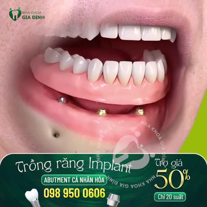 20 SUẤT TRỒNG RĂNG IMPLANT GIẢM 50% DÀNH CHO CÔ CHÚ, ANH CHỊ