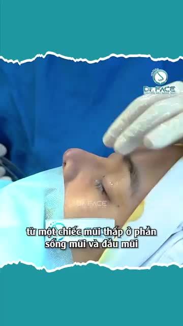 Sao phải chọn SỤN SƯỜN TOÀN PHẦN?