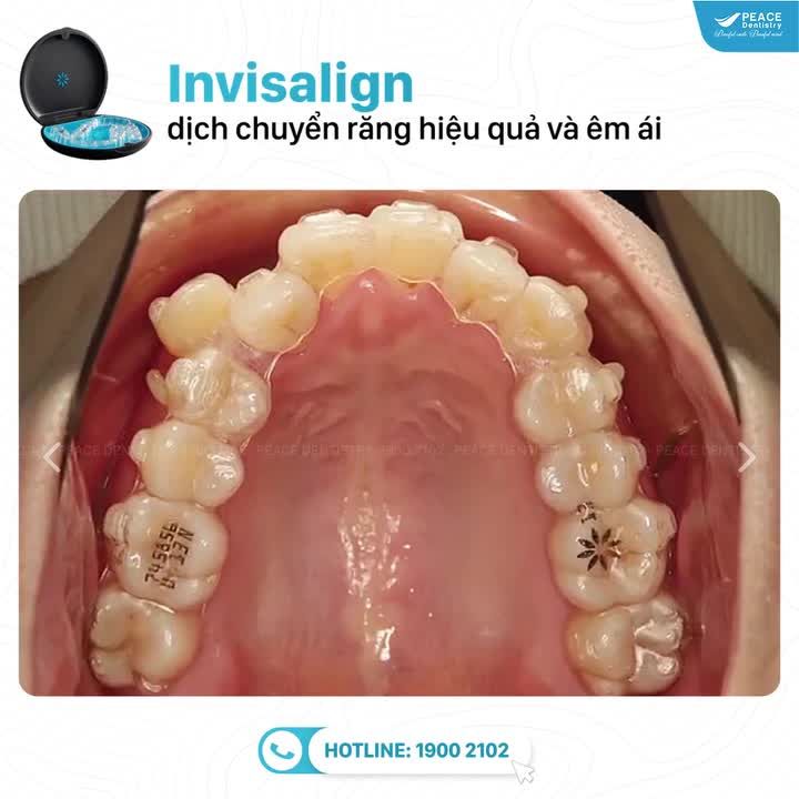 Hãy cùng Peace Dentistry xem Video của 1 trường hợp niềng răng INVISALIGN bên dưới để hình dung một cách chân thực nhất về quá trình răng di chuyển qua từng giai đoạn cũng như kết quả cuối cùng nhé!