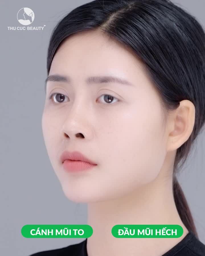 Nâng mũi TC cao cân đối đẹp tinh khôi