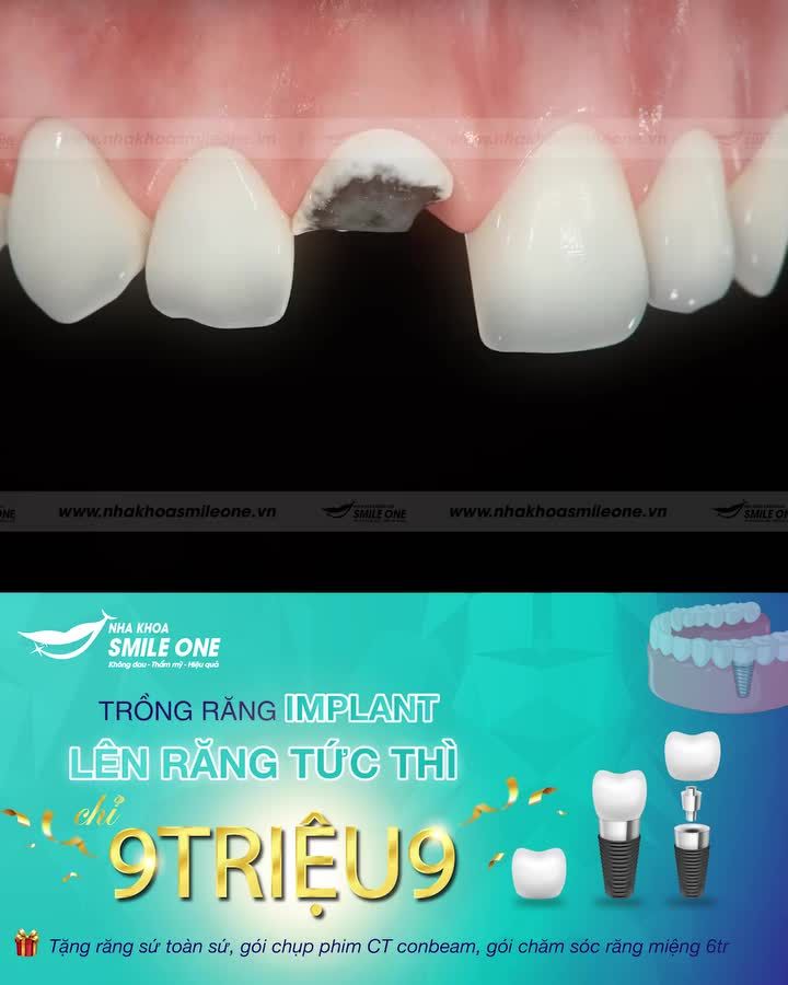 TRỒNG RĂNG IMPLANT TỨC THÌ, TIẾT KIỆM THỜI GIAN, ĂN NHAI KHỎE HƠN!