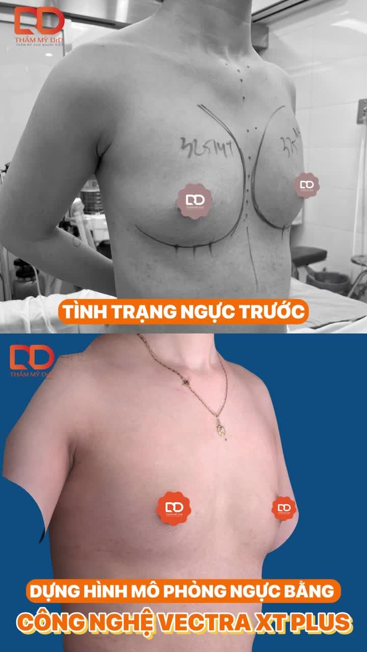TƯ VẤN TRƯỚC - CHỤP ẢNH MÔ PHỎNG 3D - KẾT QUẢ SAU PHẪU THUẬT...