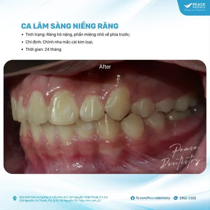 7 CÂU HỎI PHỔ BIẾN VỀ NIỀNG RĂNG HÔ