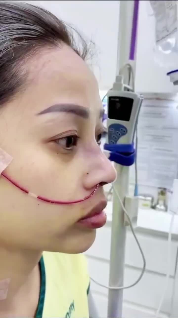 Nâng mũi cấu trúc và những ưu điểm của nó