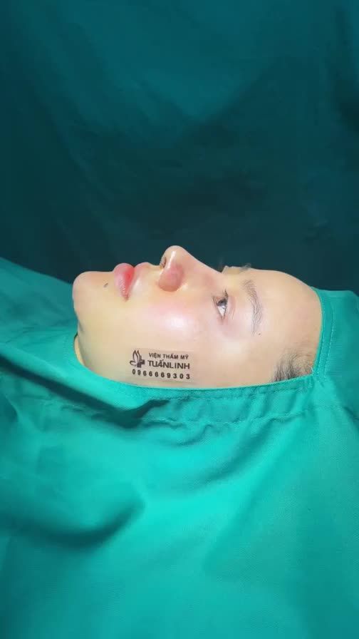 Ca nâng mũi tái cấu trúc cho bạn gái đến từ Hà Nội đã từng nâng mũi 2 lần trước đó.