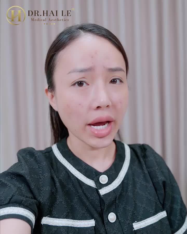 "Mụn thâm nhiều lắm, chị thử nhiều cách và tốn rất nhiều tiền rồi nhưng không cải thiện được"