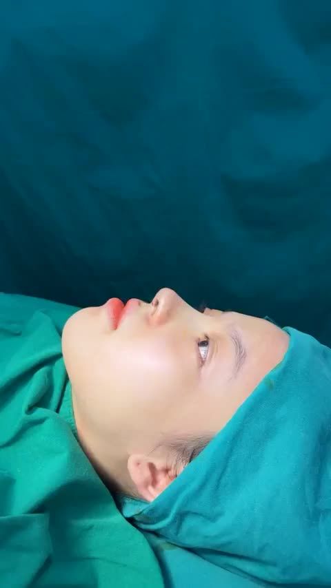 Case mũi cấu trúc vừa hoàn thành!!