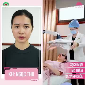 DA SÁNG KHỎE - ĐÓN HÈ SANG Trị mụn chuẩn Y khoa Acne Medic - Sạch mụn sau 1 liệu trình