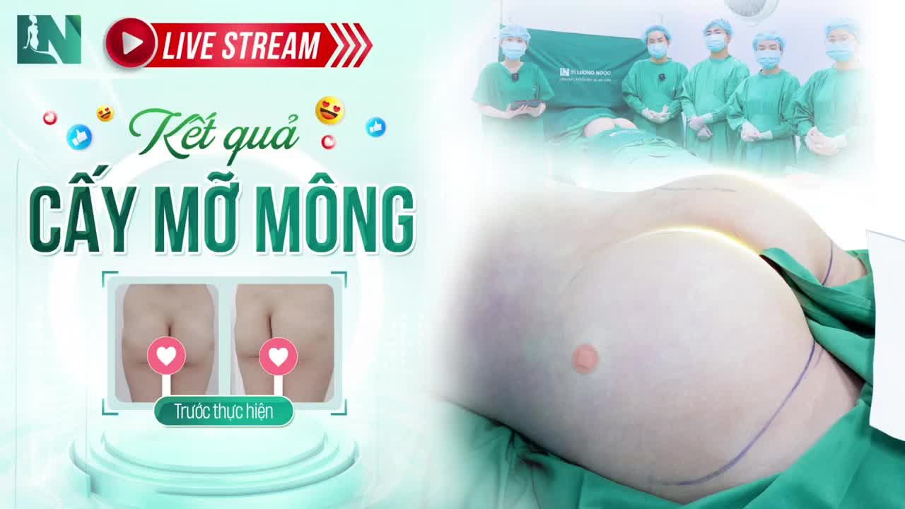 Vòng 3 cong vút, căng đầy, quyến rũ đầy tự nhiên chỉ sau 60 phút cấy mỡ mông.