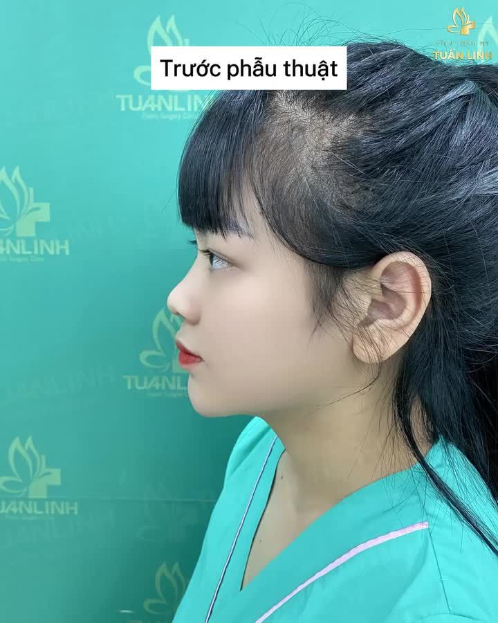 Hành trình 10 ngày sở hữu dáng mũi siêu phẩm của cô nàng GenZ!!