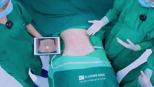 Với mong muốn sở hữu vóc dáng hoàn hảo cùng vòng eo “con kiến” hàng ngàn chị em ao ước, chị H đã tìm đến ekip Bác sĩ Lương Ngọc và thực hiện dịch vụ HÚT MỠ TẠO DÁNG vùng bụng-eo-hông và nhận được kết quả vô cùng như ý: