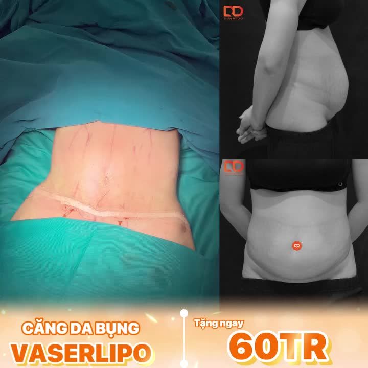 KIẾN TẠO DÁNG SON CHO BÀ MẸ 2 CON