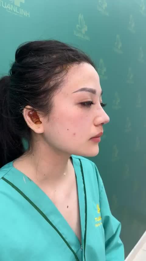 Case mũi cấu trúc vừa hoàn thành