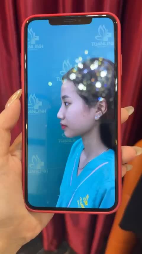 Case mũi bọc sụn sau 6 tháng