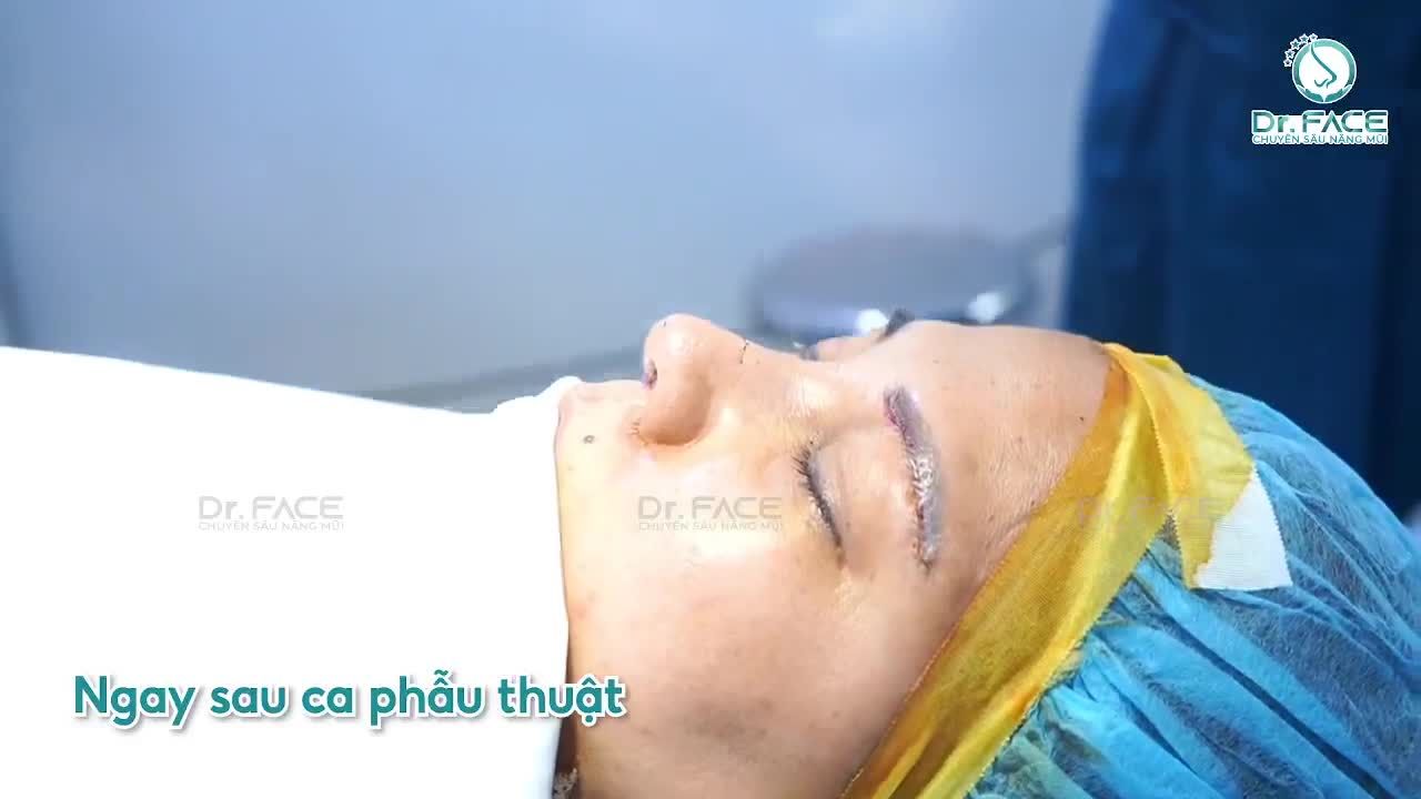 Combo nâng sụn sườn + thu cánh + nâng cung mày cho chị khách Mỹ