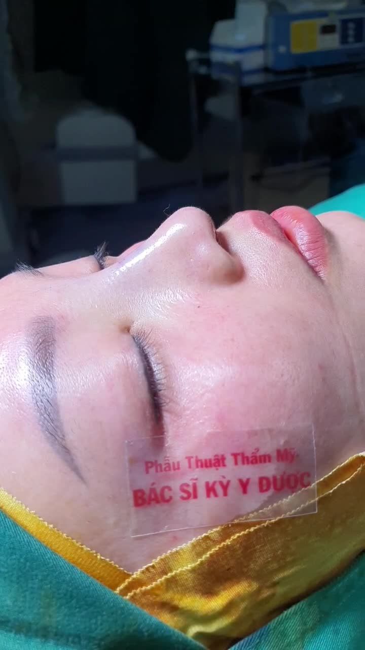 DÁNG MŨI ALINE NGAY SAU NÂNG TẠI NHA TRANG
