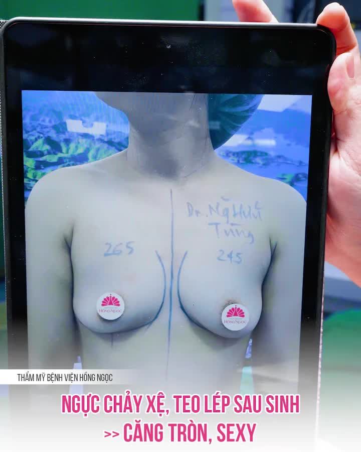 NGỰC XỆ KHÔNG TREO NHƯNG KẾT QUẢ VẪN ĐẸP MĨ MÃN