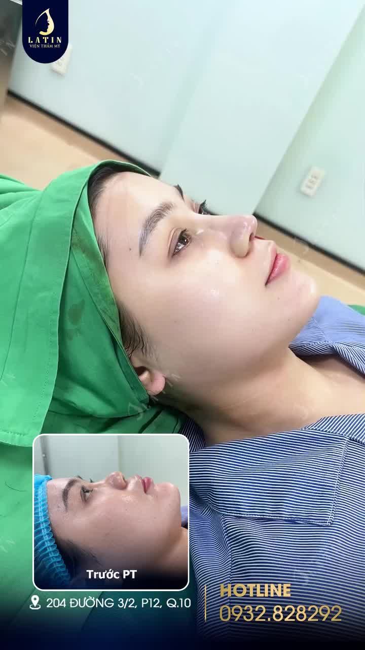 Mũi đẹp ngay sau khi làm xong là có thật đây ạ