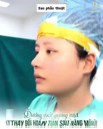 Để biết mình có thể thay đổi và xinh đẹp hơn như thế nào => Hãy nâng mũi ngay nhé!