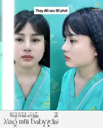 Dáng mũi siêu xinh sau 5 ngày thay nẹp