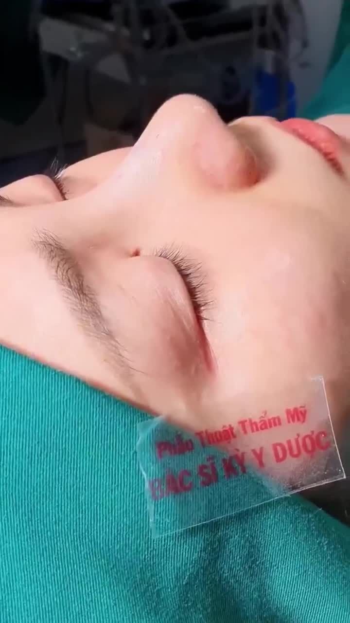 Nâng mũi ALINE tại cơ sở Nha Trang