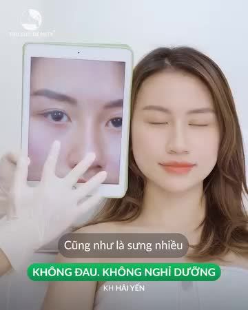 Những điều ấn tượng khi cắt mí tại THu Cúc
