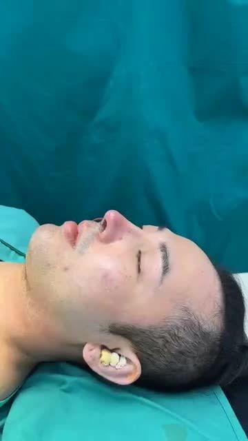 Case mũi Tái cấu trúc phức tạp vừa hoàn thành