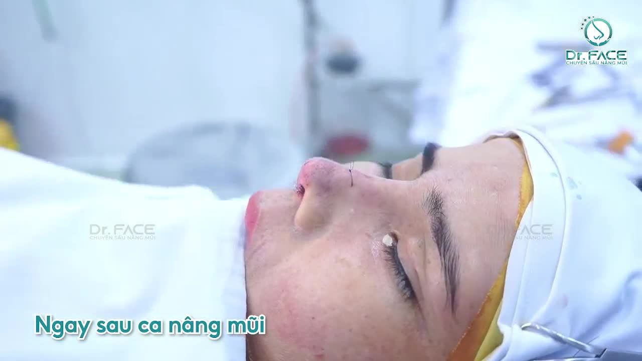 Nâng lại sụn sườn cho bạn khách bị nhọn trắng đầu mũi