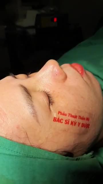 Nâng mũi ALINE bán cấu trúc 2 lớp. Phẫu thuật êm ái nhẹ nhàng. Dáng mũi tự nhiên, thanh thoát.