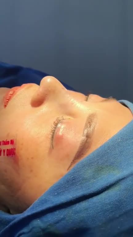 Nâng Mũi ALINE Bán Cấu Trúc 2 lớp