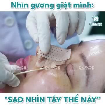 Feedback chân thực của khách hàng sau 2 tháng nâng ngực