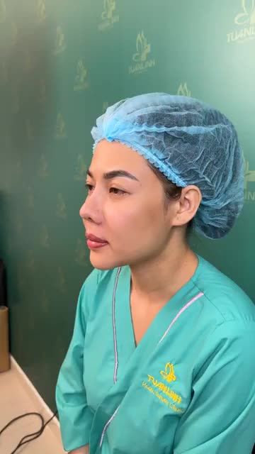 Case Độn rãnh cười cho khách hàng đã từng nâng mũi + độn cằm sau 1 năm rưỡi tại Tuấn Linh.