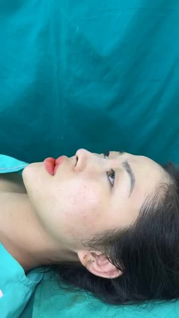 Mũi bọc sụn giá trọn gói 15 Triệu - Có trả góp 0% Lãi.