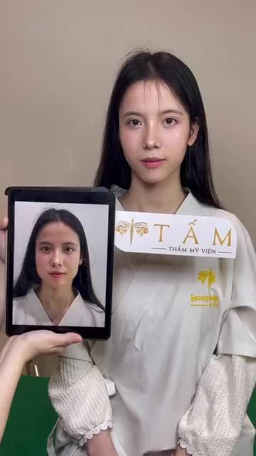 MÀN LỘT XÁC CỦA CHỊ KHÁCH HÀNG SAU LIỆU TRÌNH THON GỌN HÀM TẠI TẤM