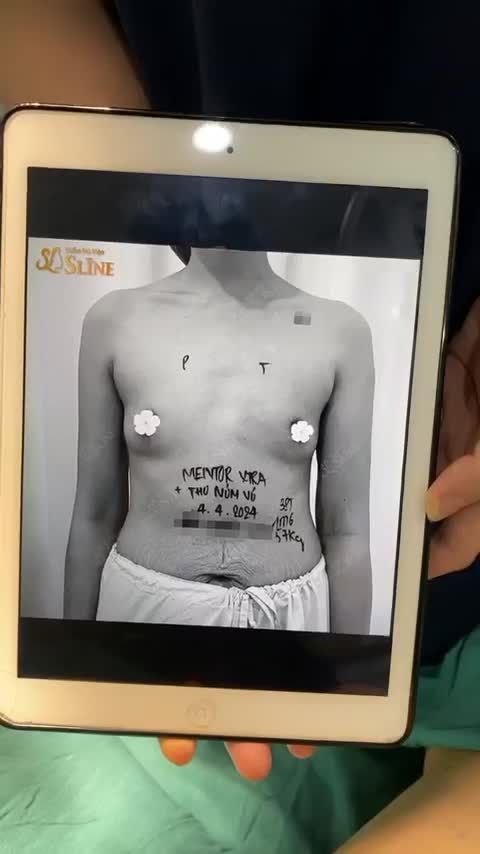THAY ĐỔI VÒNG 1 TEO LÉP SAU SINH CON