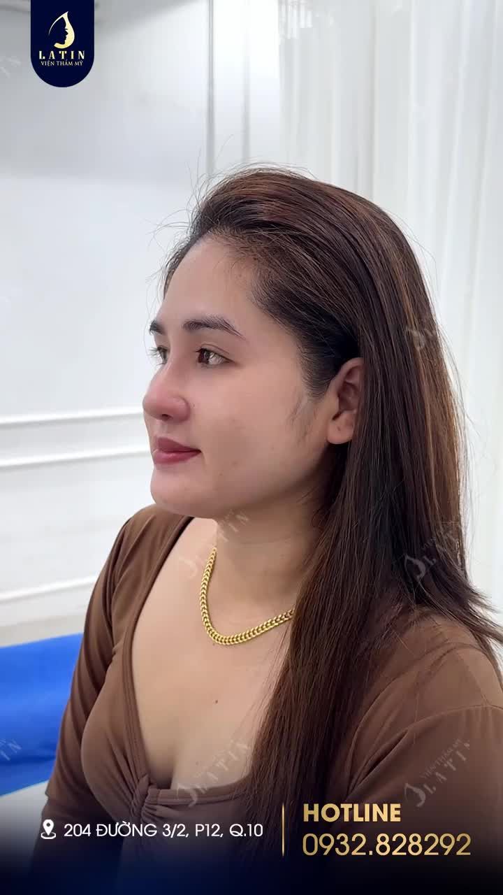 Chị gái chia sẻ kinh nghiệm sau 10 ngày nâng mũi
