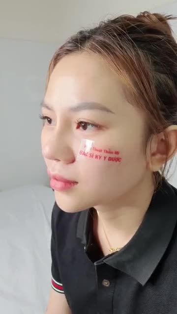 Tạm biệt mũi thấp trũng, đón mũi cao sang. Chỉ sau 60 phút phẫu thuật, từ 1 chiếc mũi: