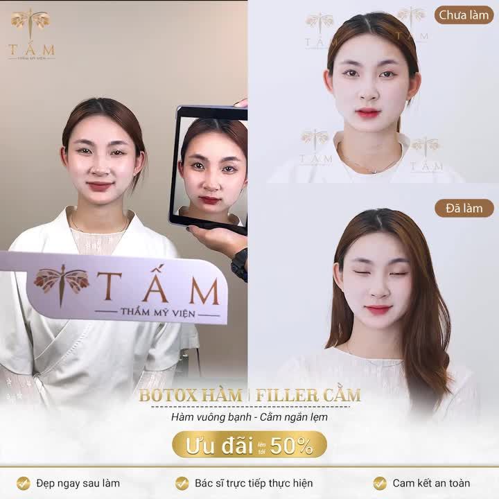 TÍN HIỆU VŨ TRỤ "BẠN SẼ HỐI HẬN NẾU KHÔNG LÀM COMBO BOTOX HÀM+FILLER CẰM" NGAY!