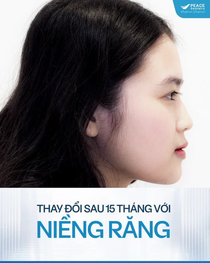 Ở ĐÂY CÓ CHÚT VITAMIN ĐỘNG LỰC cho các đồng niềng đây 1 ca niềng răng mắc cài về đích chỉ sau 15 tháng (đặc biệt không nhổ răng) tại Peace Dentistry.