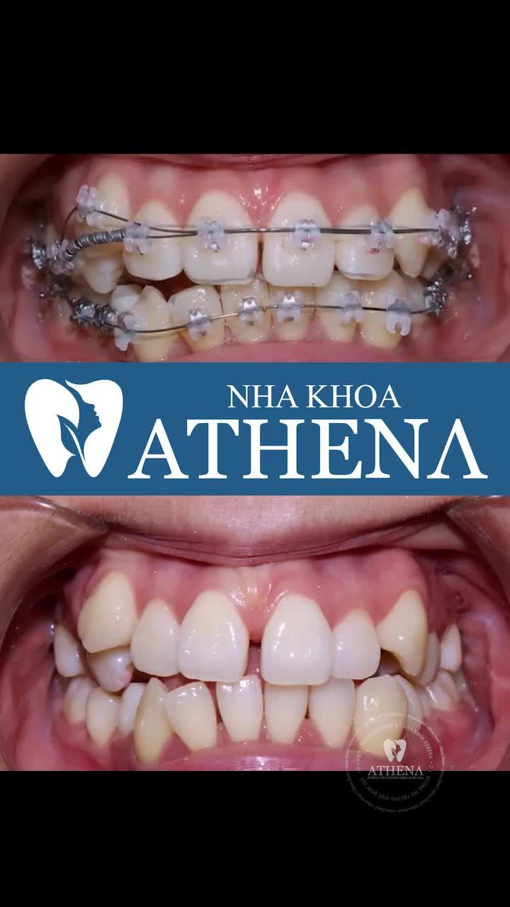 Sự dịch chuyển của răng khấp khểnh nha khoa uy tin nha khoa athena niêng răng